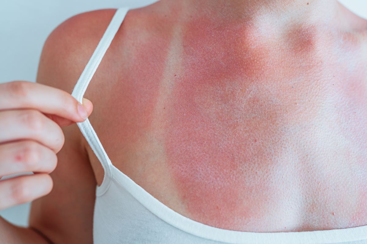 Sonnenbrand in Waldshut vermeiden – Tipps zum Schutz und zur